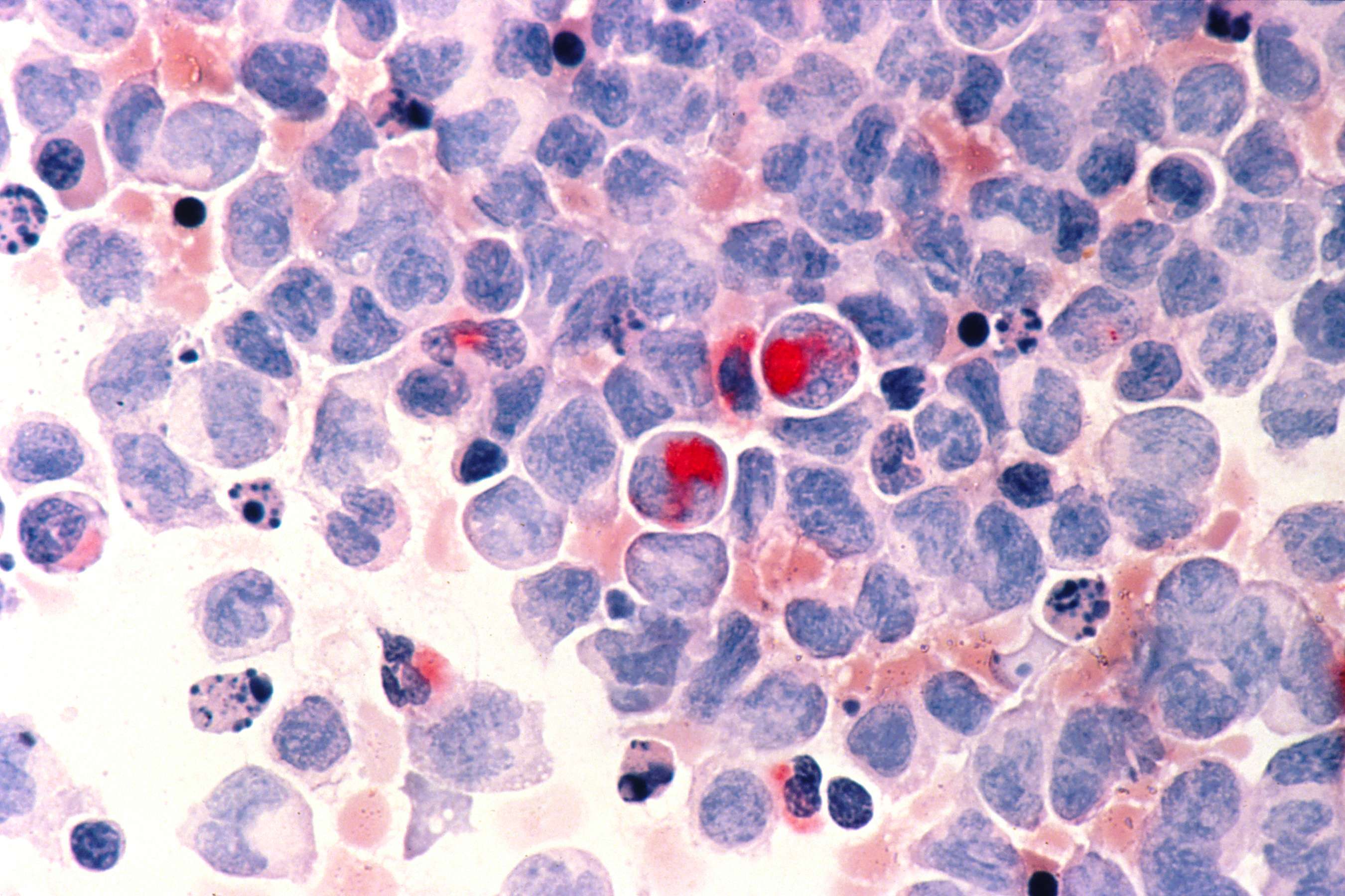 Leucemia Mieloide Aguda