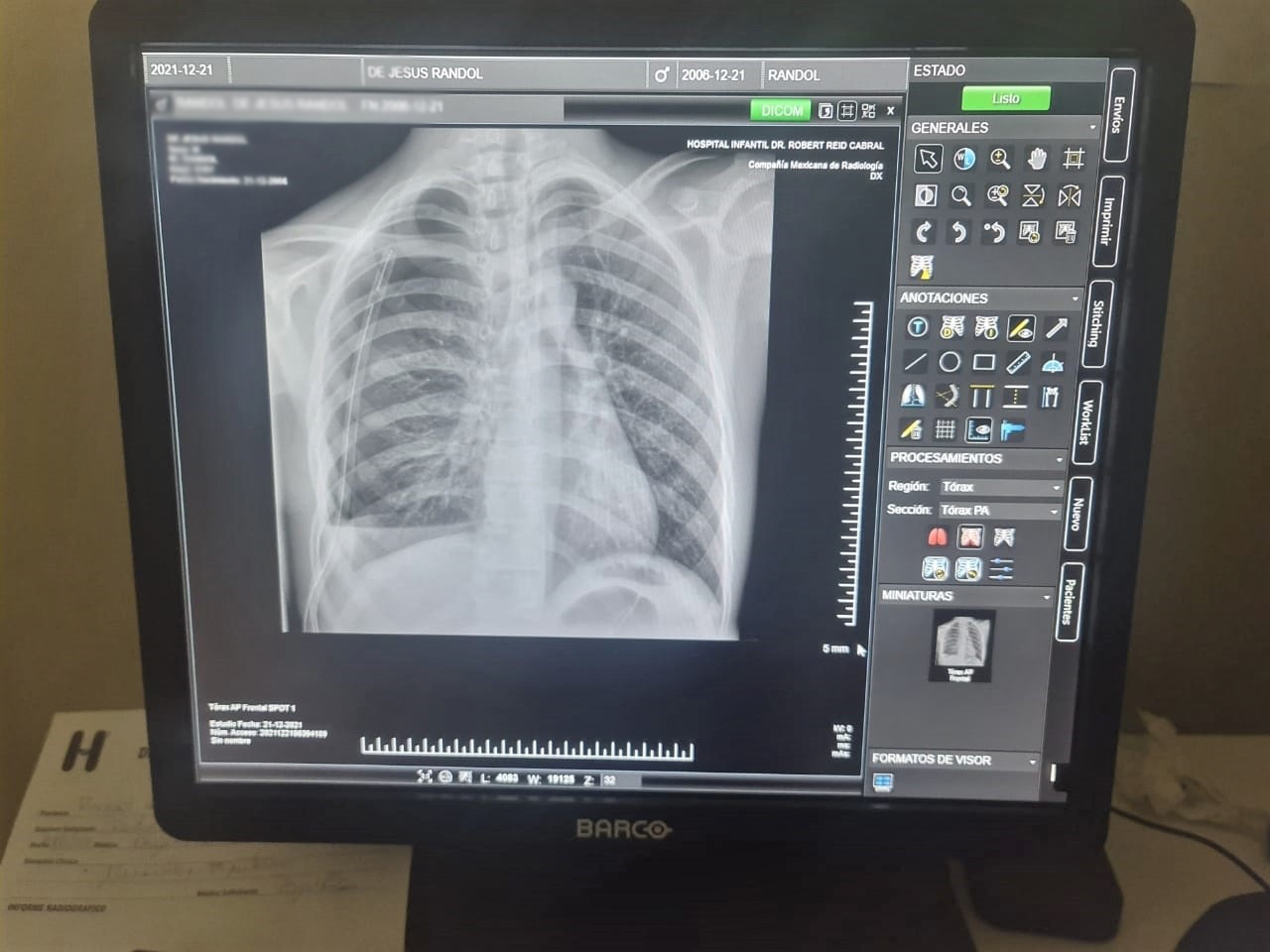 Hospital Robert Reid Cabral instala moderno equipo digital rayos X con