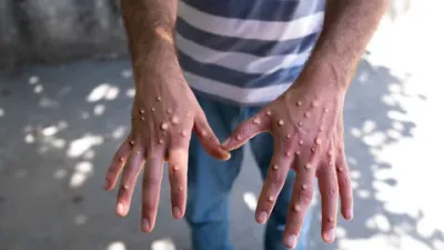 EEUU advierte sobre el rebrote de la viruela del mono en África. (Foto: fuente externa)