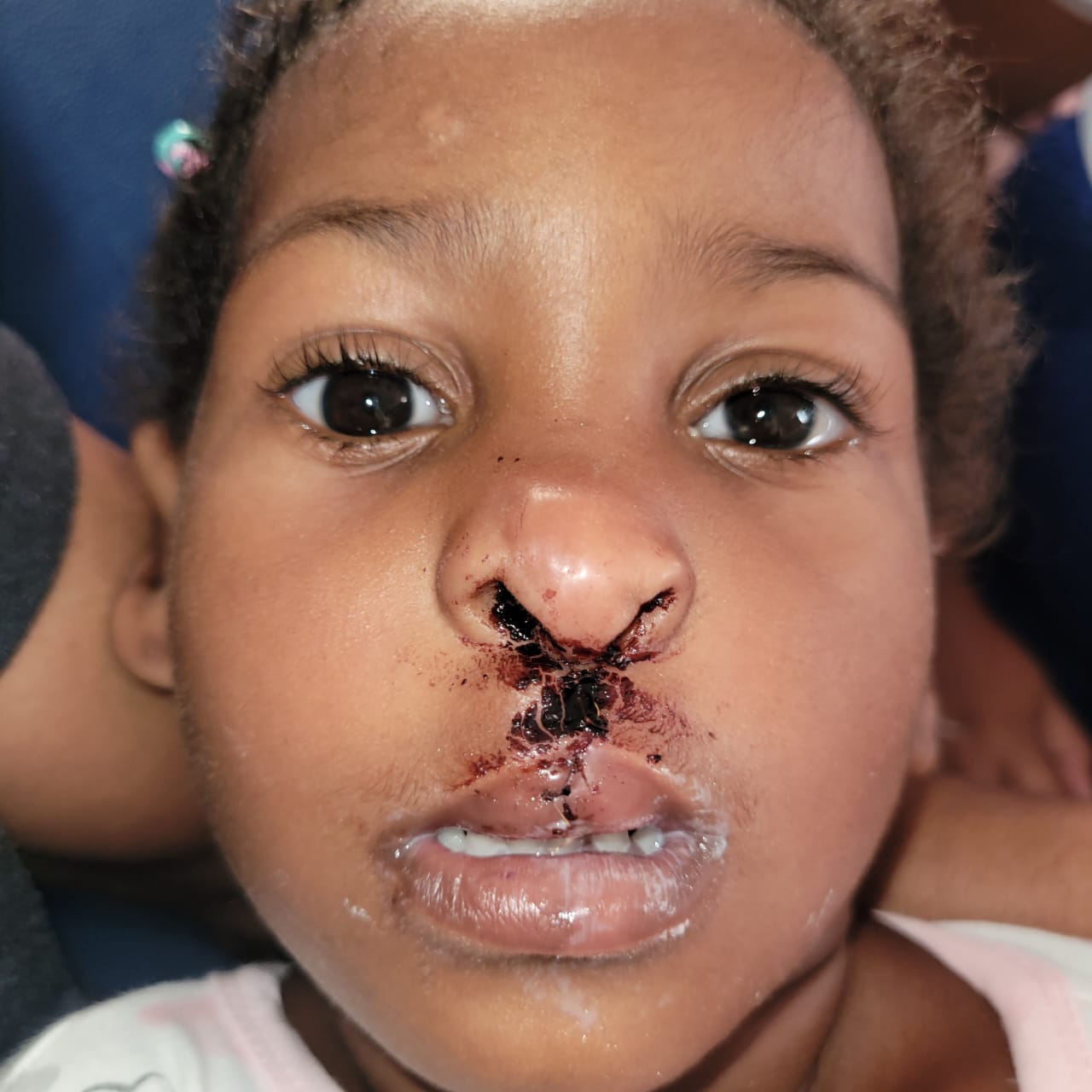 Cruz Jiminián inicia Jornada de cirugías para labios leporinos y paladar hendido