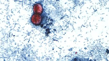 EE. UU. indaga casi 7,000 casos del parásito Cyclospora que causa diarrea severa