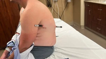 Un senderista caminó seis horas con un bastón atravesándole el torso en EE. UU.